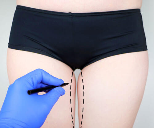 thigh-lift