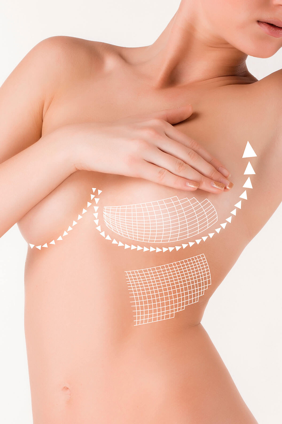 breast-lift