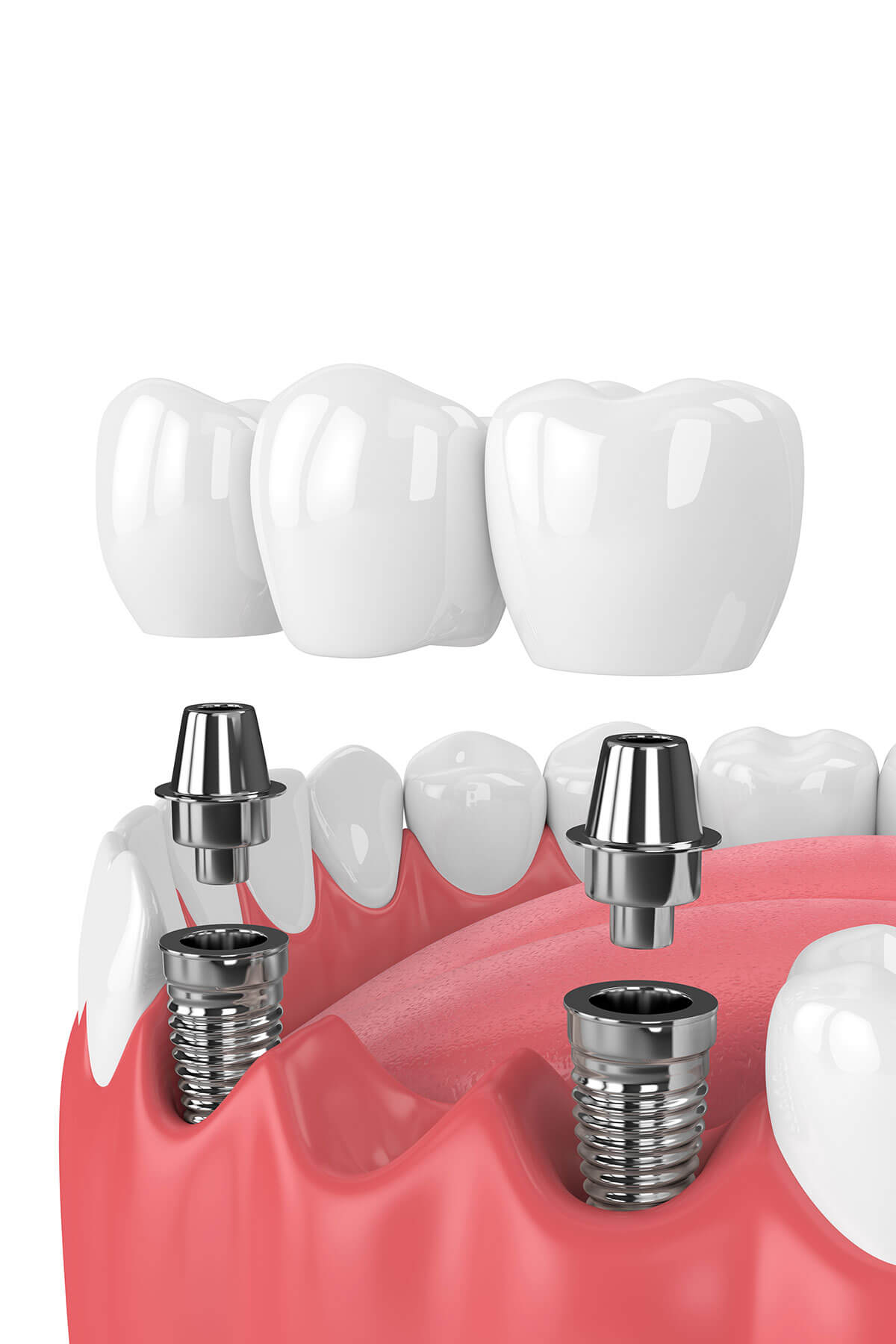 dental-implant
