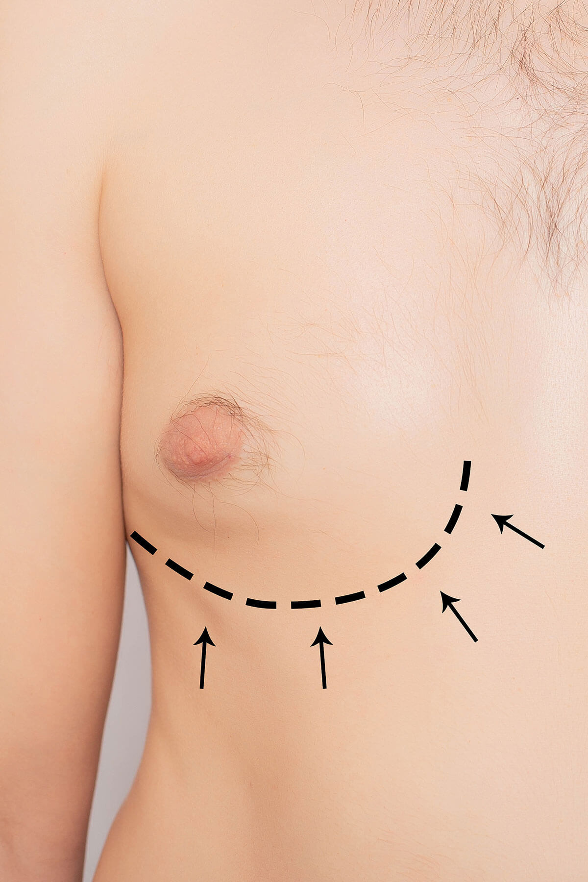 gynecomastia